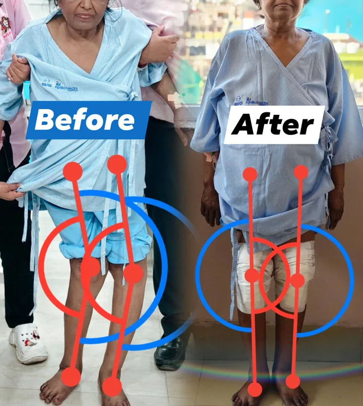 Before and after hip replacement result — patient at BIG Apollo Spectra Hospital, Patna