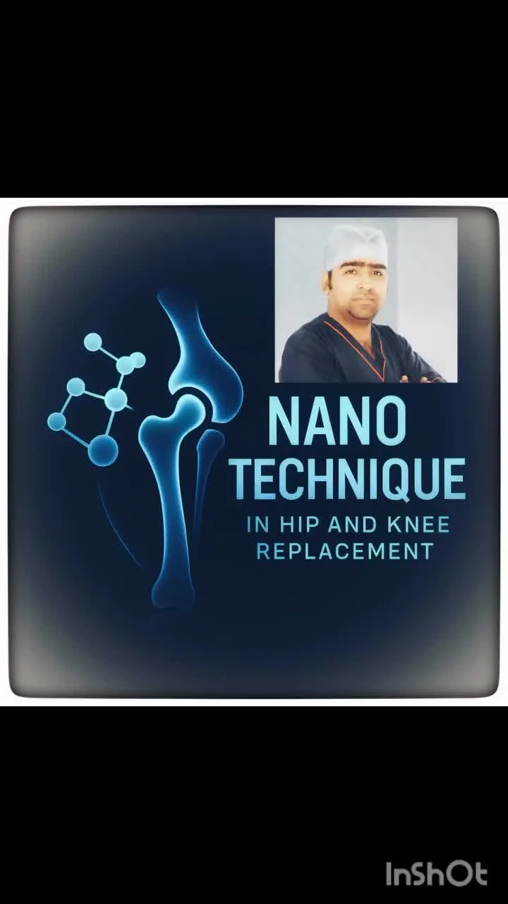 Real patient recovery after Nano Technique joint replacement — walking within days of surgery by Dr. Amit Sinha, Patna